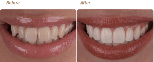 1e1d315d-before-and-after-2023-01-06t115301-047_1000000000000000000028